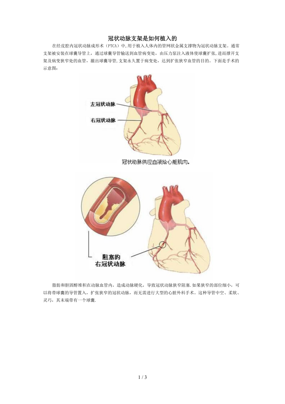 冠状动脉支架是如何植入的_第1页