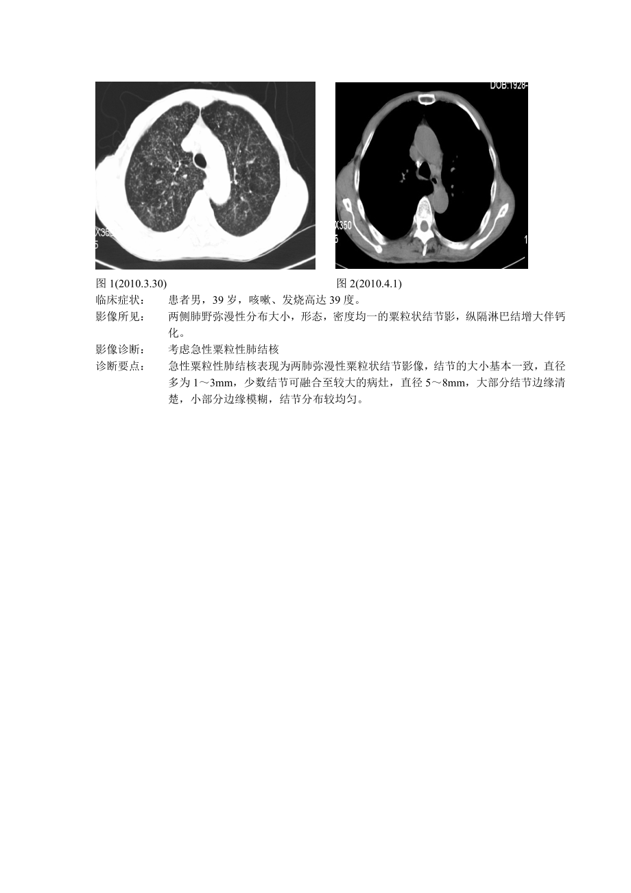 急性粟粒性肺结核_第1页