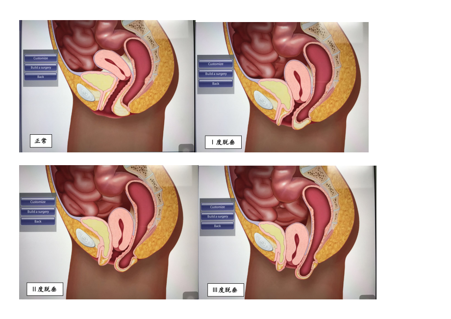 子宫脱垂图解_第1页