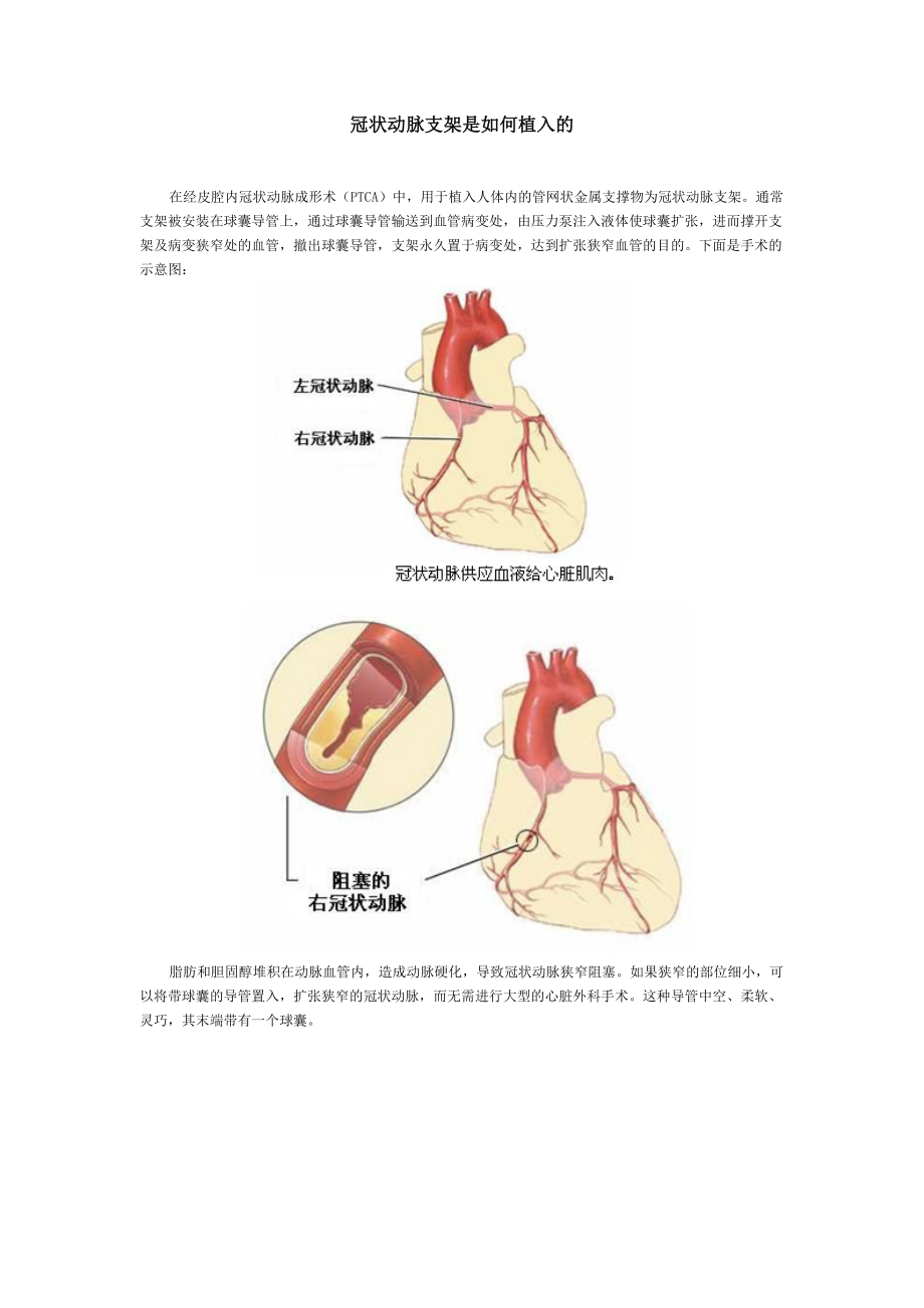 冠状动脉支架是如何植入的_第1页