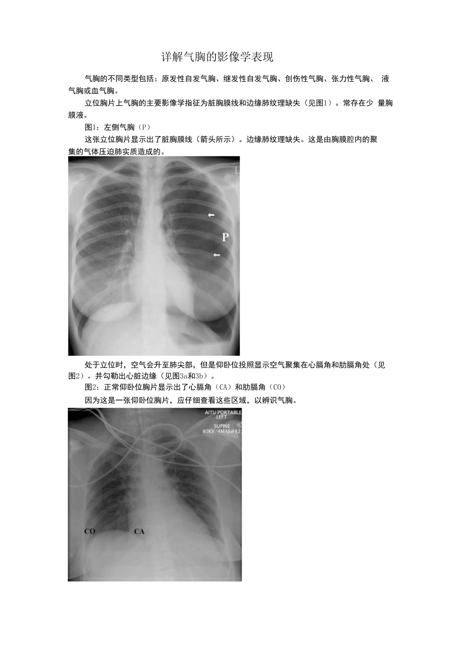 详解气胸的影像学表现_第1页