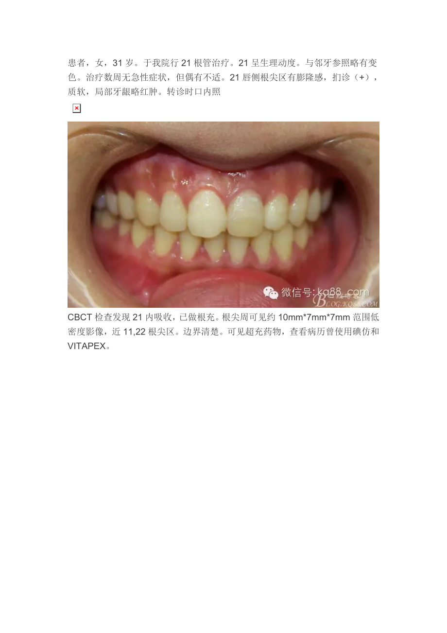 王汉禹前牙根尖囊肿根尖切除手术_第1页